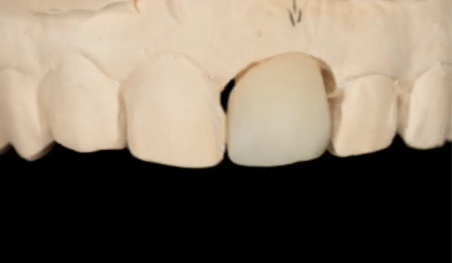 MISO restoration on the model